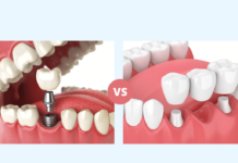 Single-Tooth Implant vs Bridge: Making the Right Choice